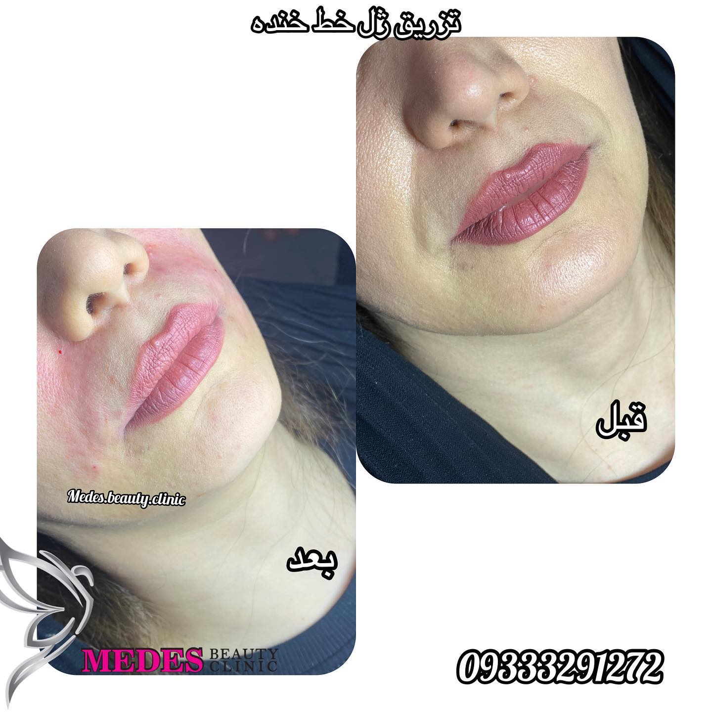 تزریق ژل خط خنده